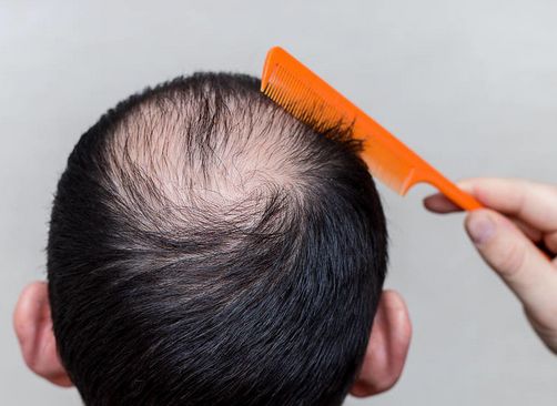 脱发涉及到哪些因素呢?<a href='/' target='_blank' title='青岛皮肤病医院'><span style='color: #0000ff'><strong>青岛皮肤病医院</strong></span></a>详细介绍5个因素