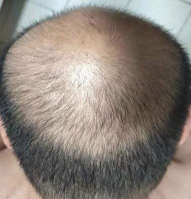 【脱发专科重点公布】哪些食物有助于防止脱发?三大青岛脱发研究院